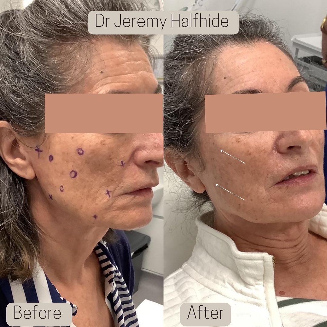 Facial Thread Lift - Tightening the tissues in the cheek area.