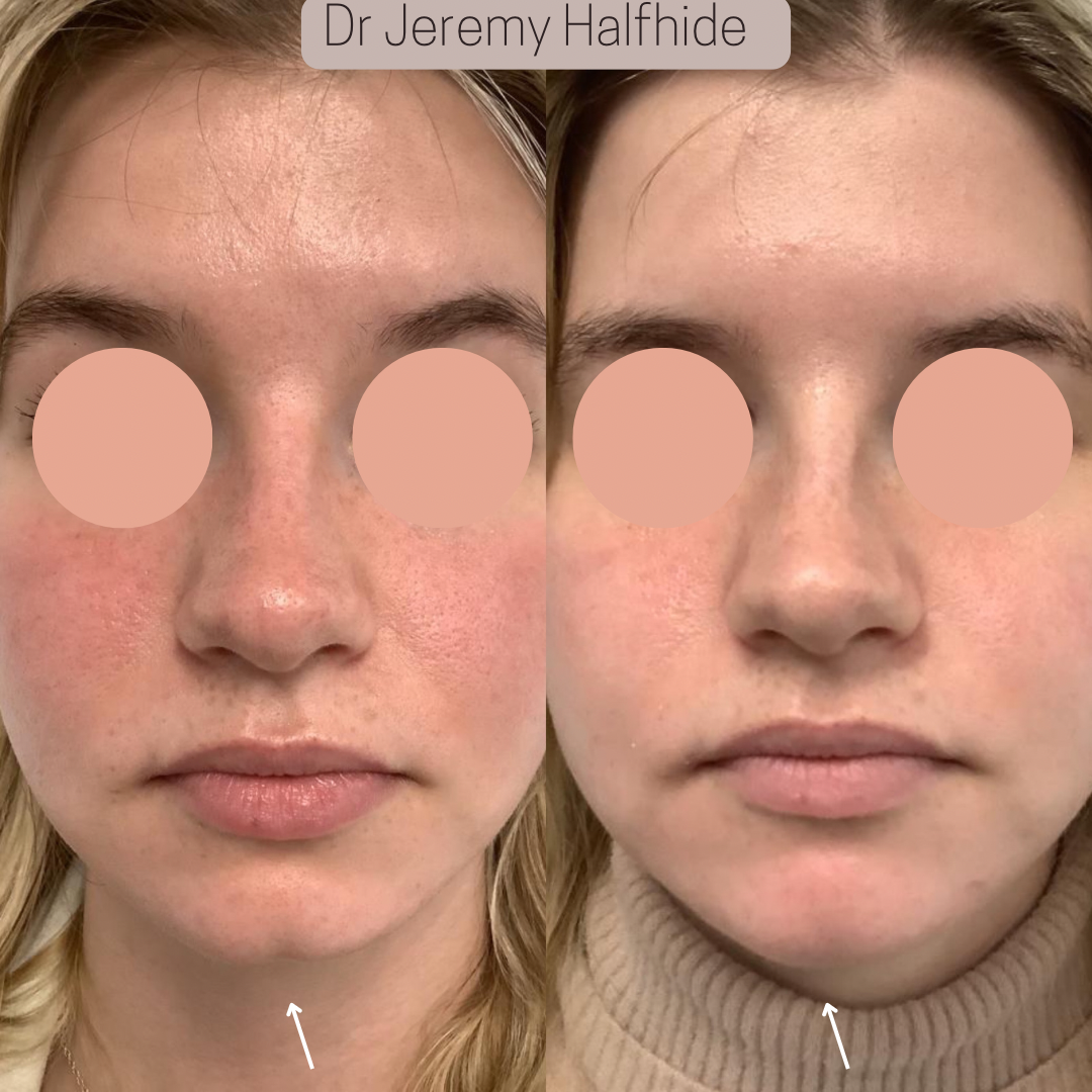 30 minutes later, after chin augmentation with enhanced facial proportions and improved aesthetic appearance.