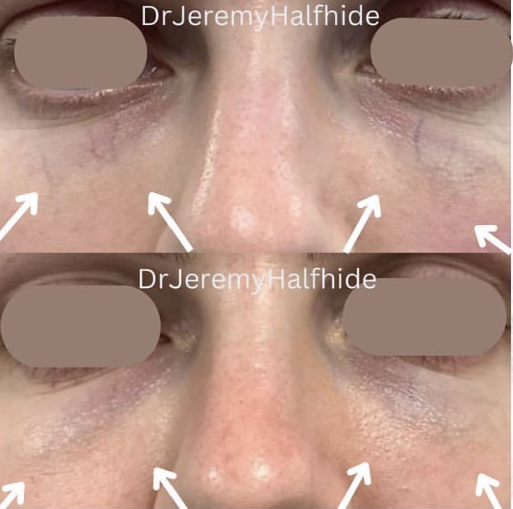 Patient concern: Visible blue veins under the eye. Just 3 sessions to achieve this result.