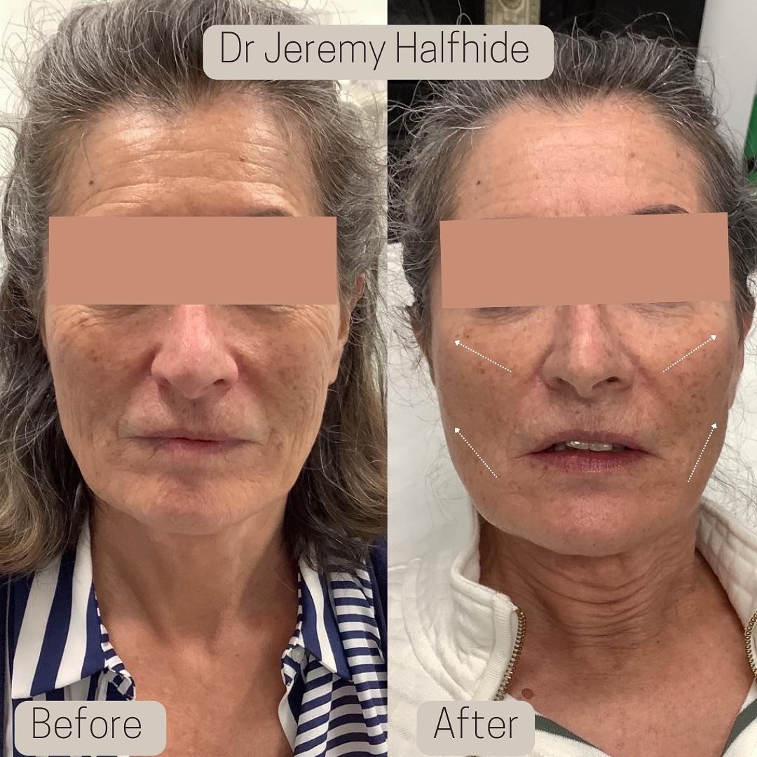 Full lifting effect - Provides a framework to support sagging skin.