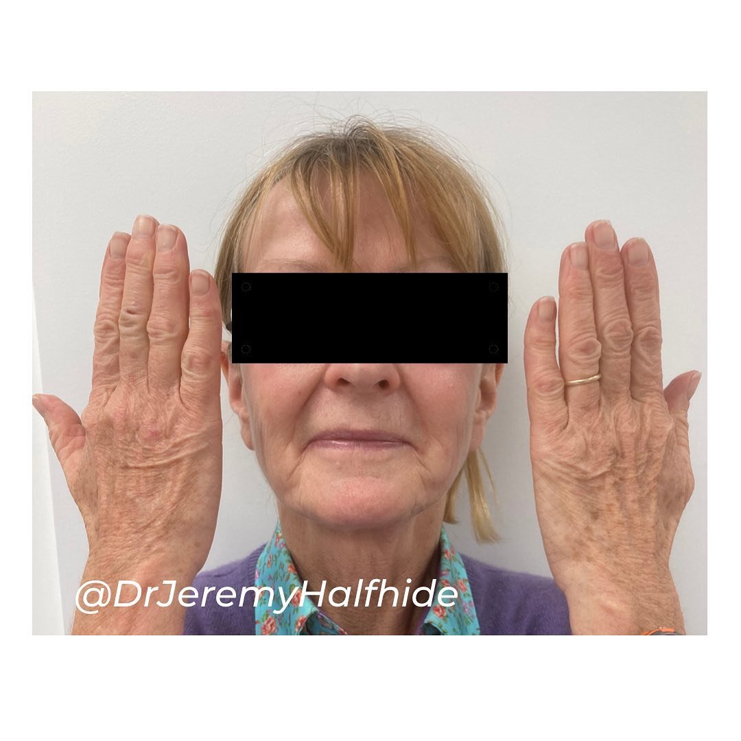Age (Liver Spots) from sun damage*
This patient is comparing her untreated hands to her face which shows a huge difference in the ageing process.
Face & Body can be treated if required.