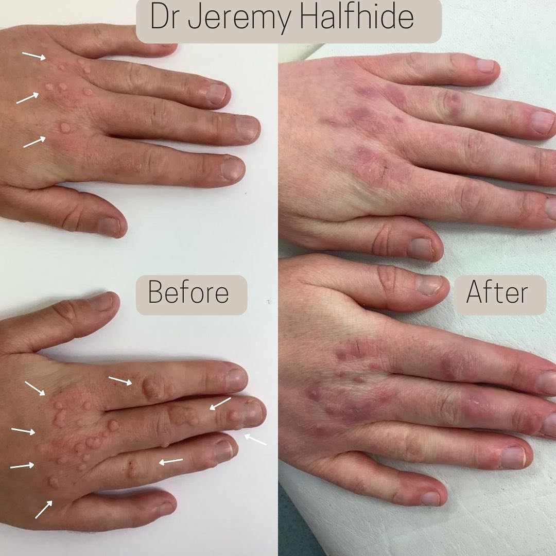 Multiple Warts treated with laser. Very tricky to treat on the hands. Usually patients have tried multiple attempts to freeze them off which always leads to reoccurrence. Surgical removal is never a good option due to where it is, the area will not h