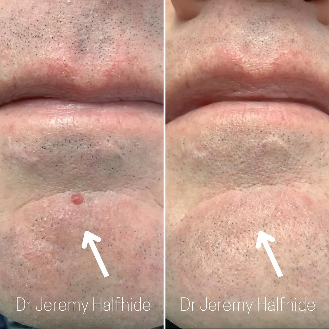 Vascular Lesion removal