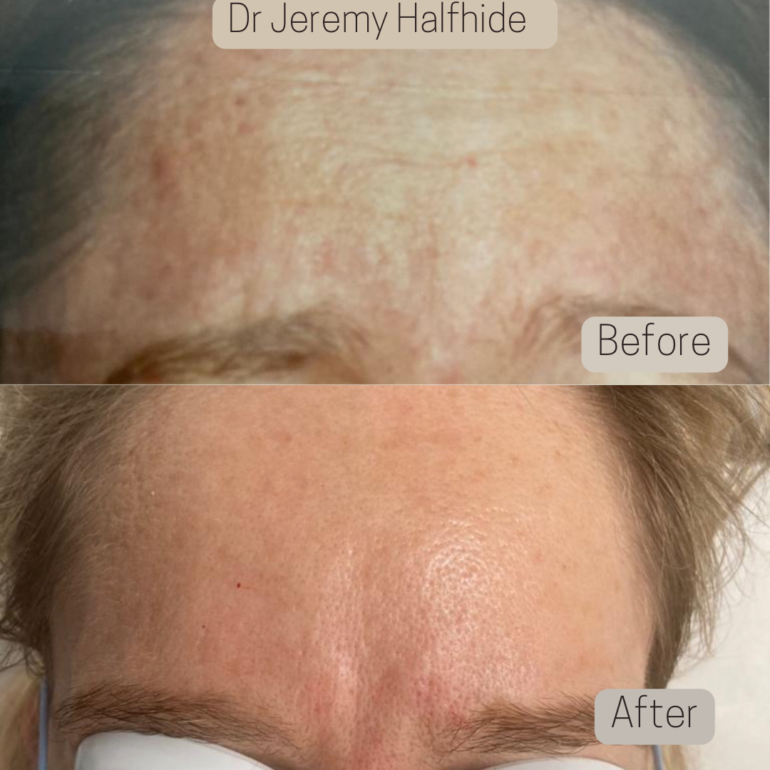 25 years of prevention! This patient has been with me from the beginning and through safely using anti-wrinkle injections she has successfully prevented the signs of ageing.
These photos are taken 20+ years apart. WOW!