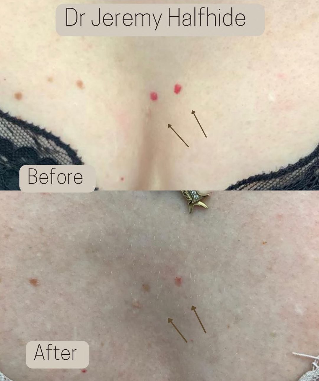 Multiple vascular lesion removal