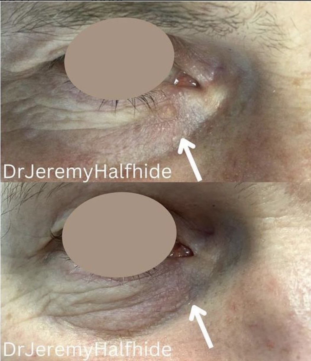 Patient Concern: lump adjacent to his eye, before and 3 months after one laser treatment.