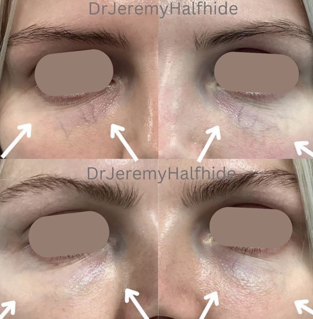 Patient concern: Visible blue veins under the eye.