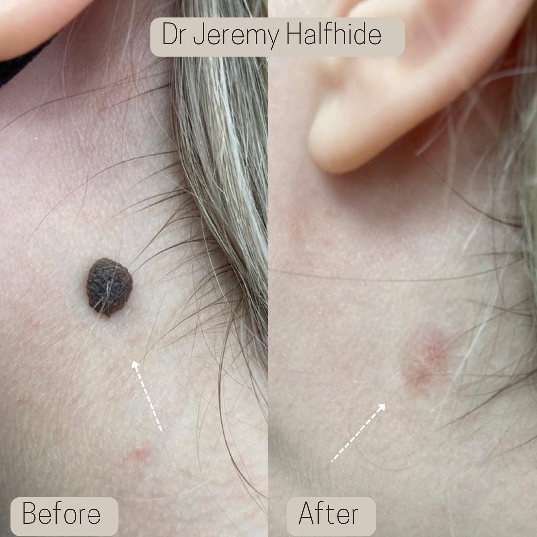 Large nodular Mole - Removed with Laser. The redness seen immediately after treatment will fade over a few months. Scarring will be minimal if any.