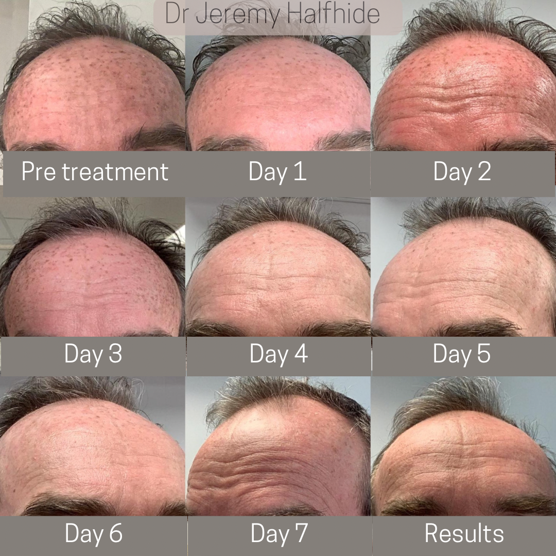 Many sunspots (lentiginosis) from long-term sun exposure, cleared with just one treatment session of Fraxel laser. 
This is a series of daily pictures showing clearance over seven days. Slight redness in early photos, but able to continue working nor