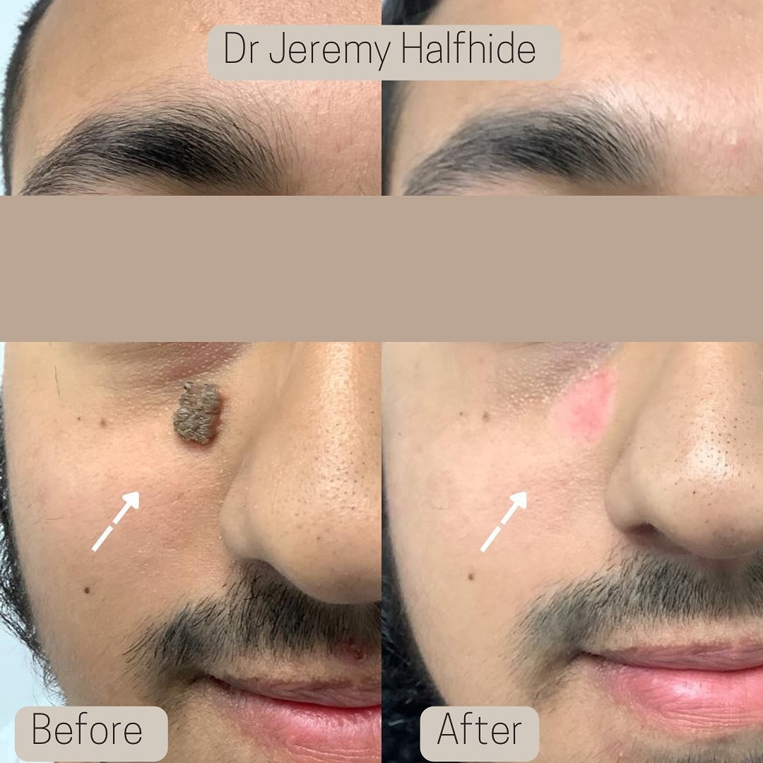 Large nodular Mole - Removed with Laser. The redness seen immediately after treatment will fade over a few months. Scarring will be minimal if any.