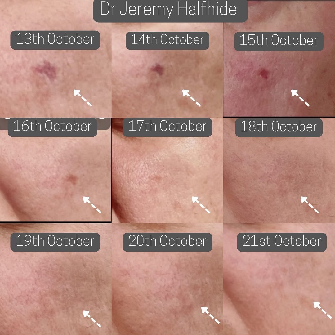 Laser (healing example - patients photos*)