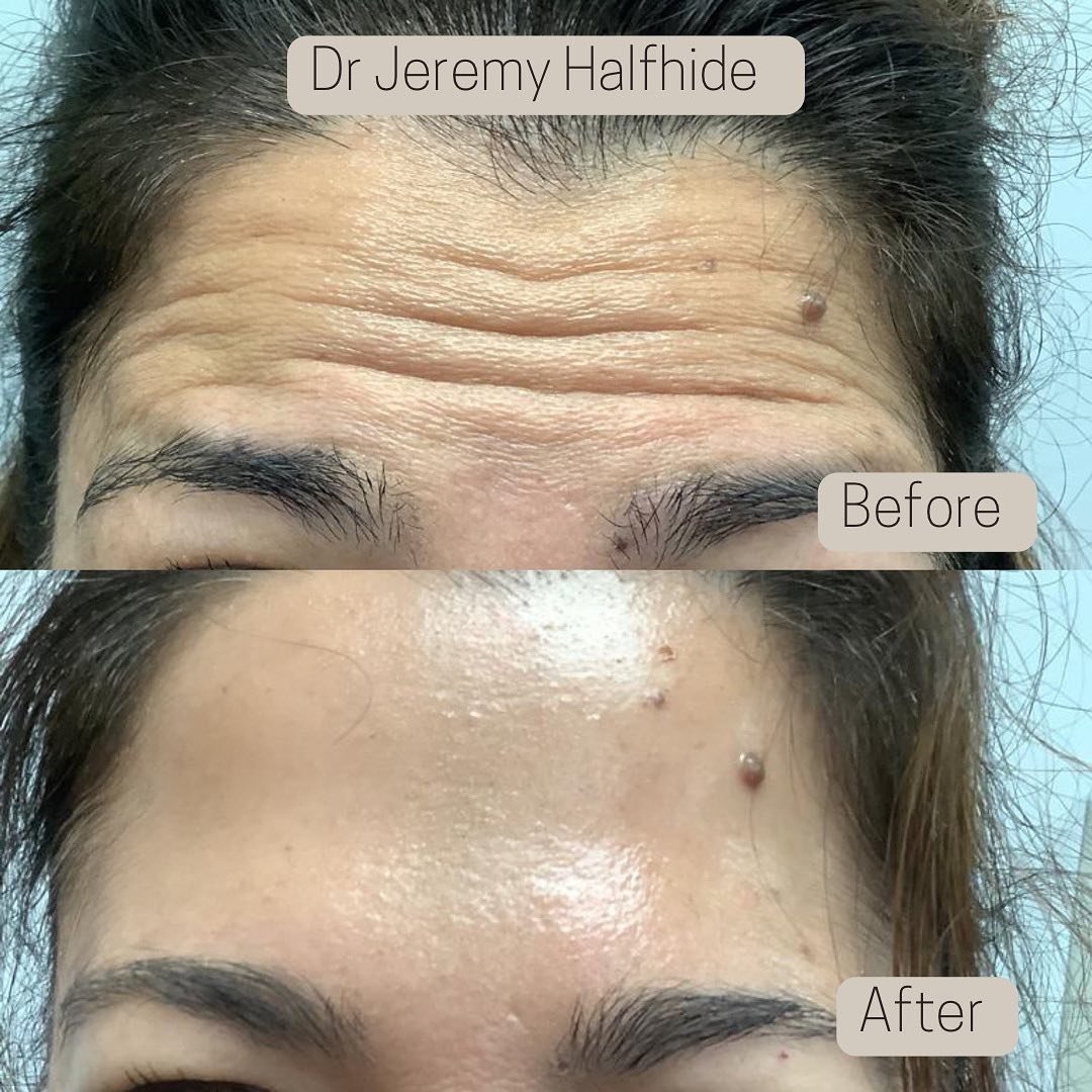 Forehead lines