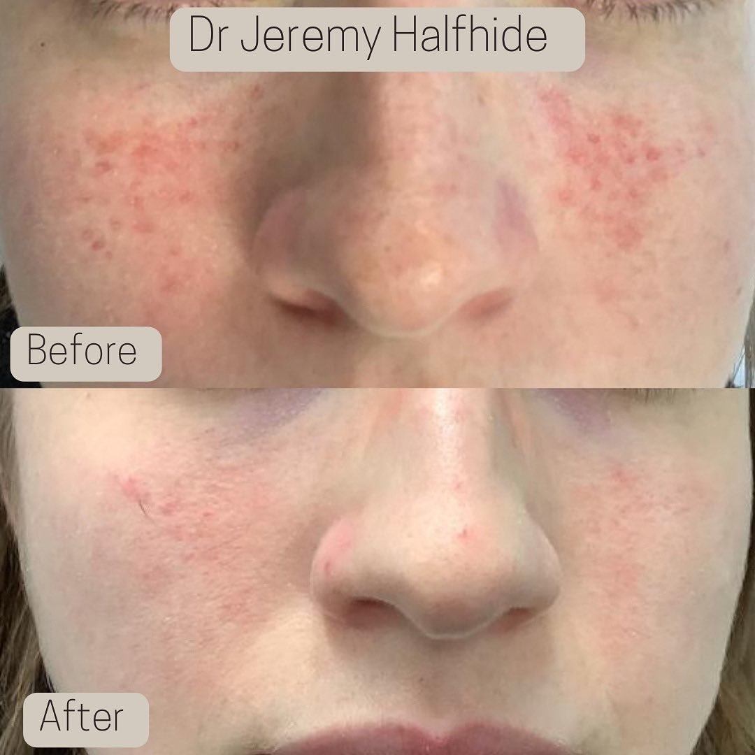 Rosacea - improved with laser treatment.