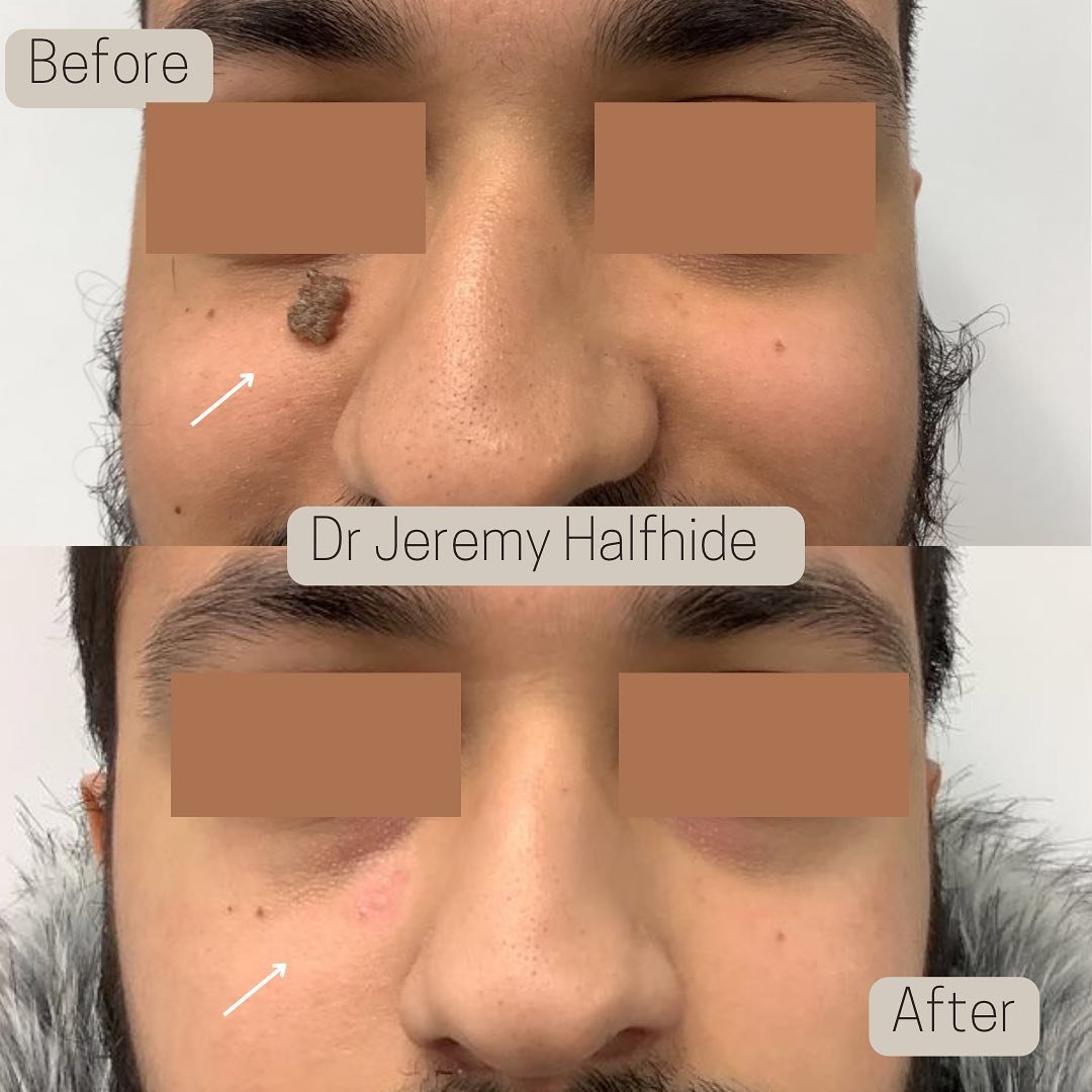 Previous photo follow up - few months on and healing looks great. Can be covered with camouflage make up if that is patient's preference.