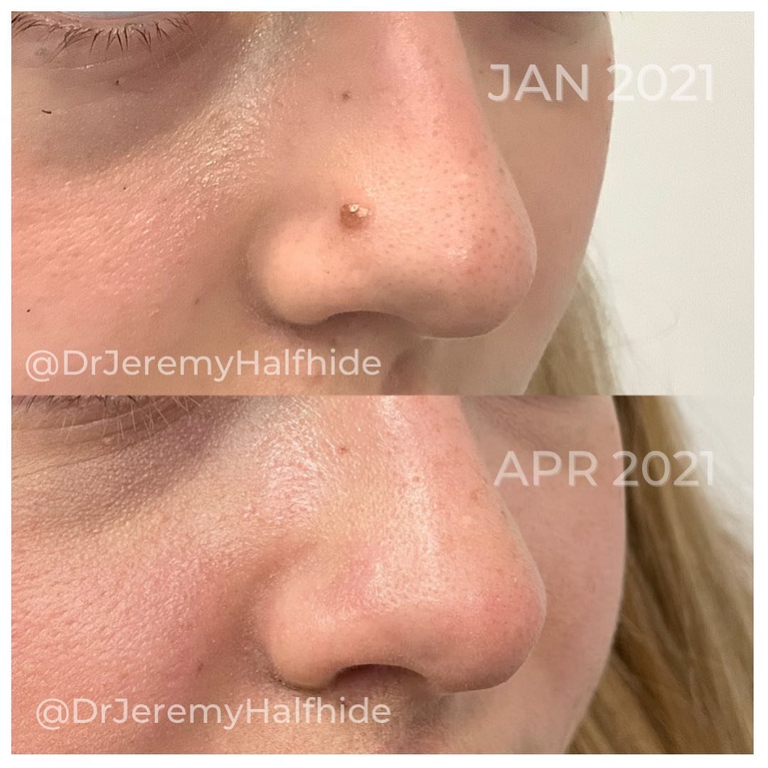 Laser Mole removal - 10 minute procedure and a fantastic result.