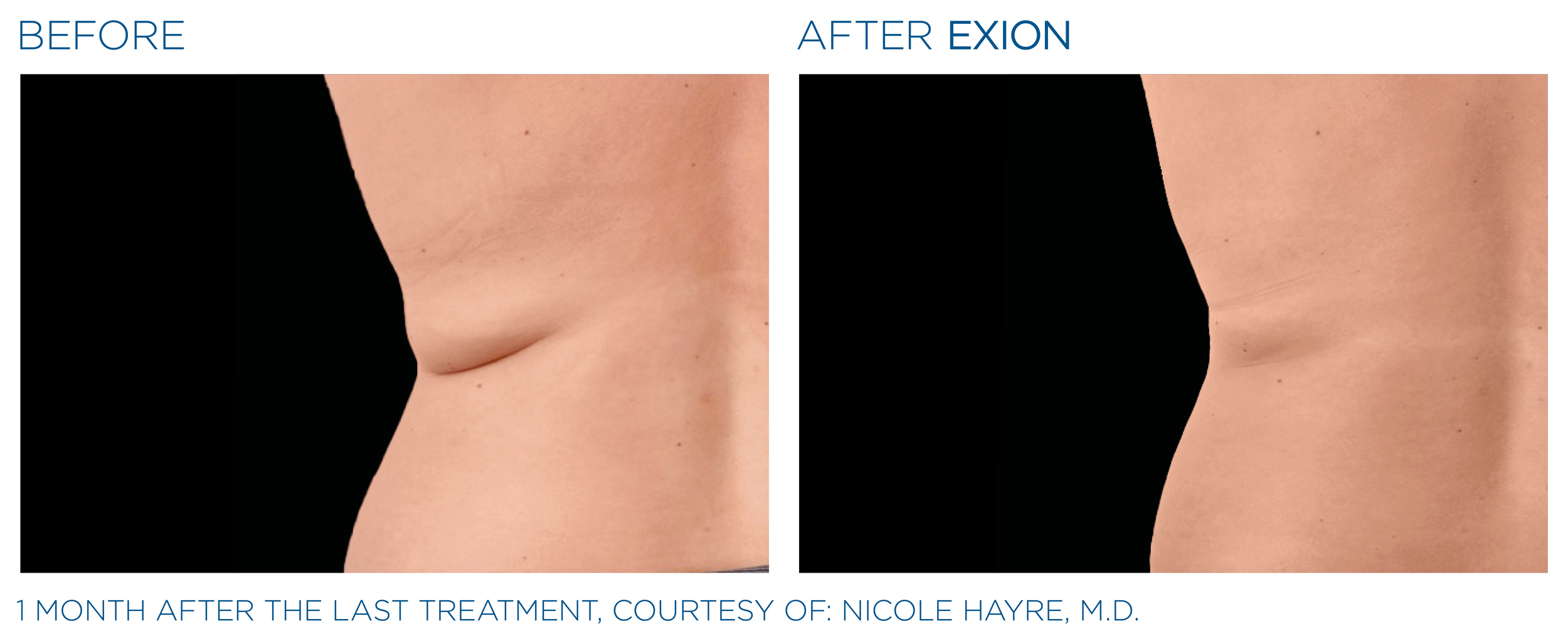 Exion_PIC_Ba-card-back-female-012_Body_ENUS100.png