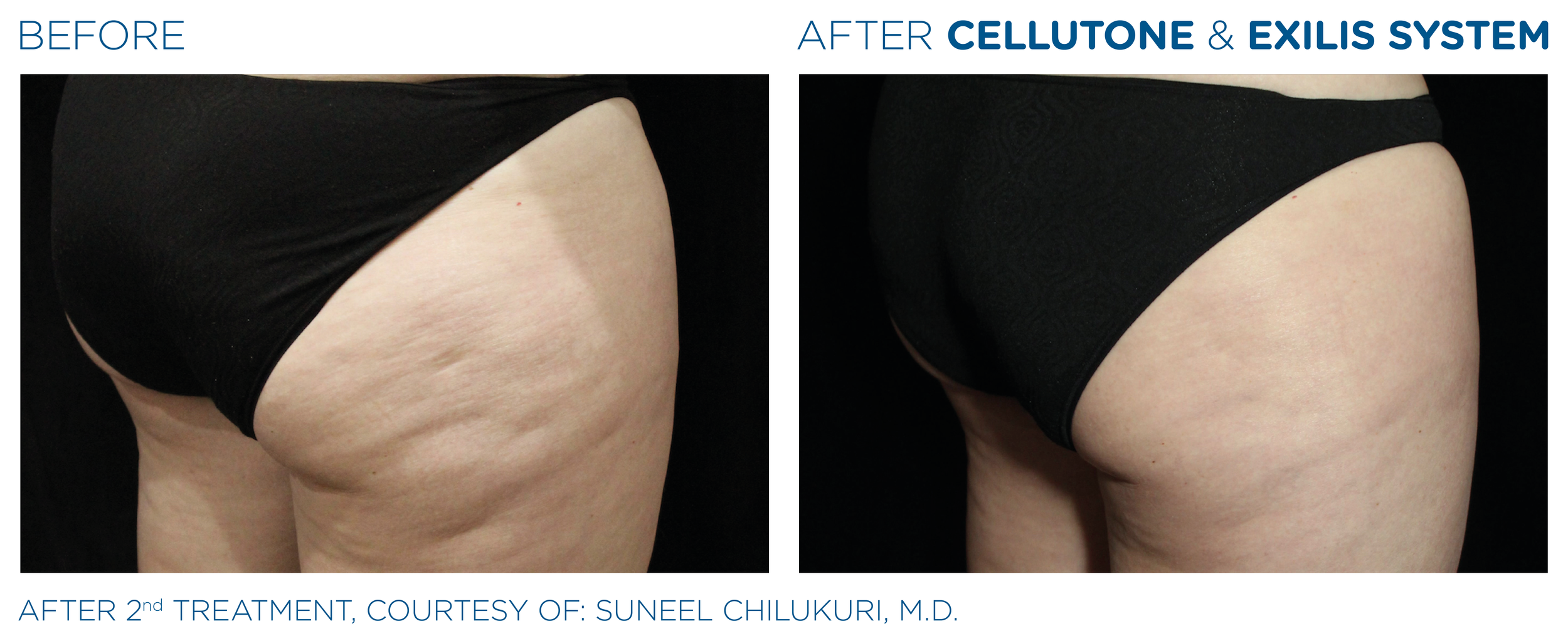 Cellutone-Exilis_System_PIC_Ba-card-female-buttock-001_ENUS100.png