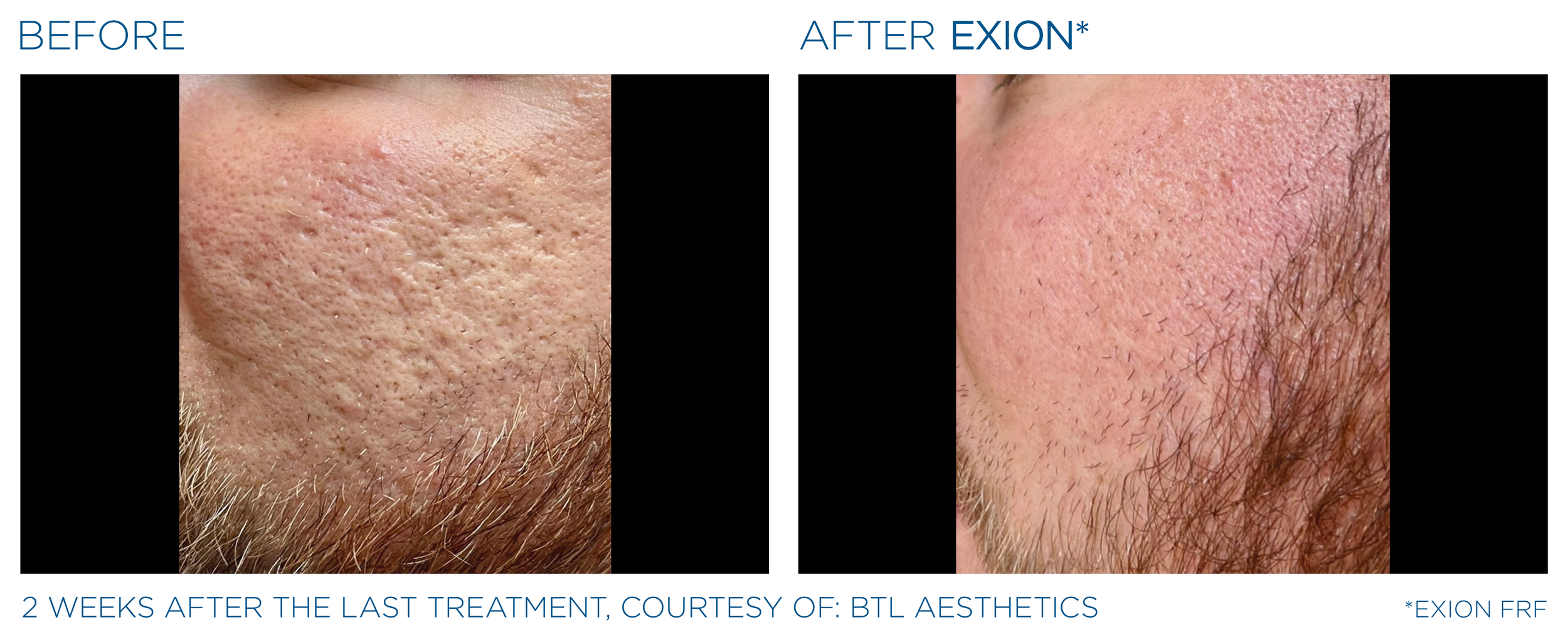 Exion_PIC_Ba-card-cheeks-male-010_FRF_ENUS100.png