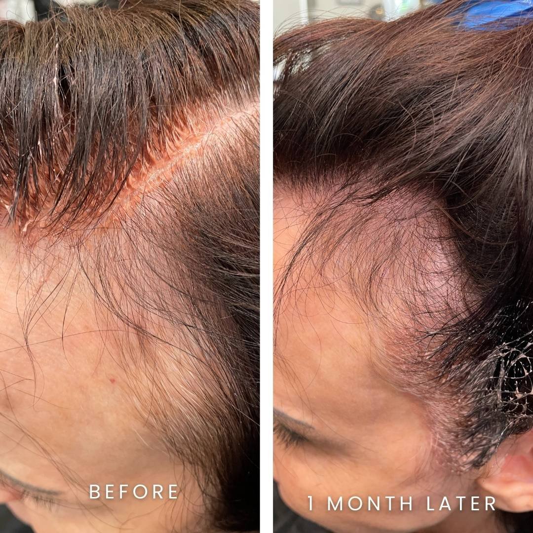 Hair Restoration with PRP