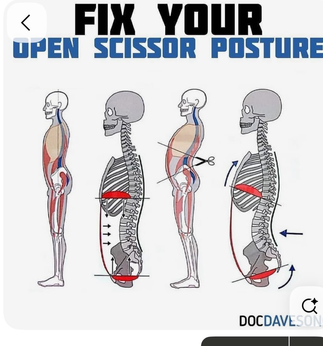 When the hips are not neutral- anterior tilts like this picture, you will not get flat tummy but will have lower back pain issues sooner or later