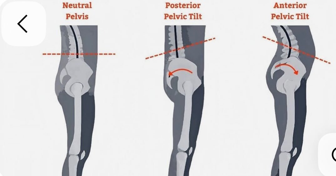 It is important to keep hips neutral to keep the spine to be healthy