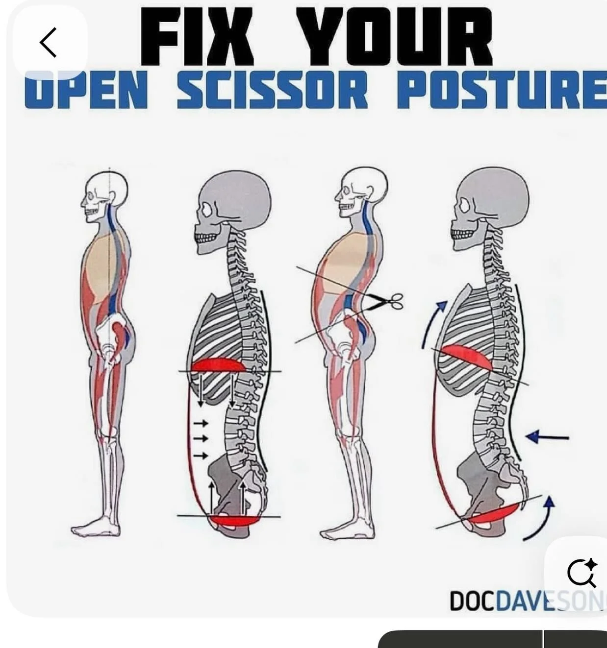 When the hips are not neutral- anterior tilts like this picture, you will not get flat tummy but will have lower back pain issues sooner or later