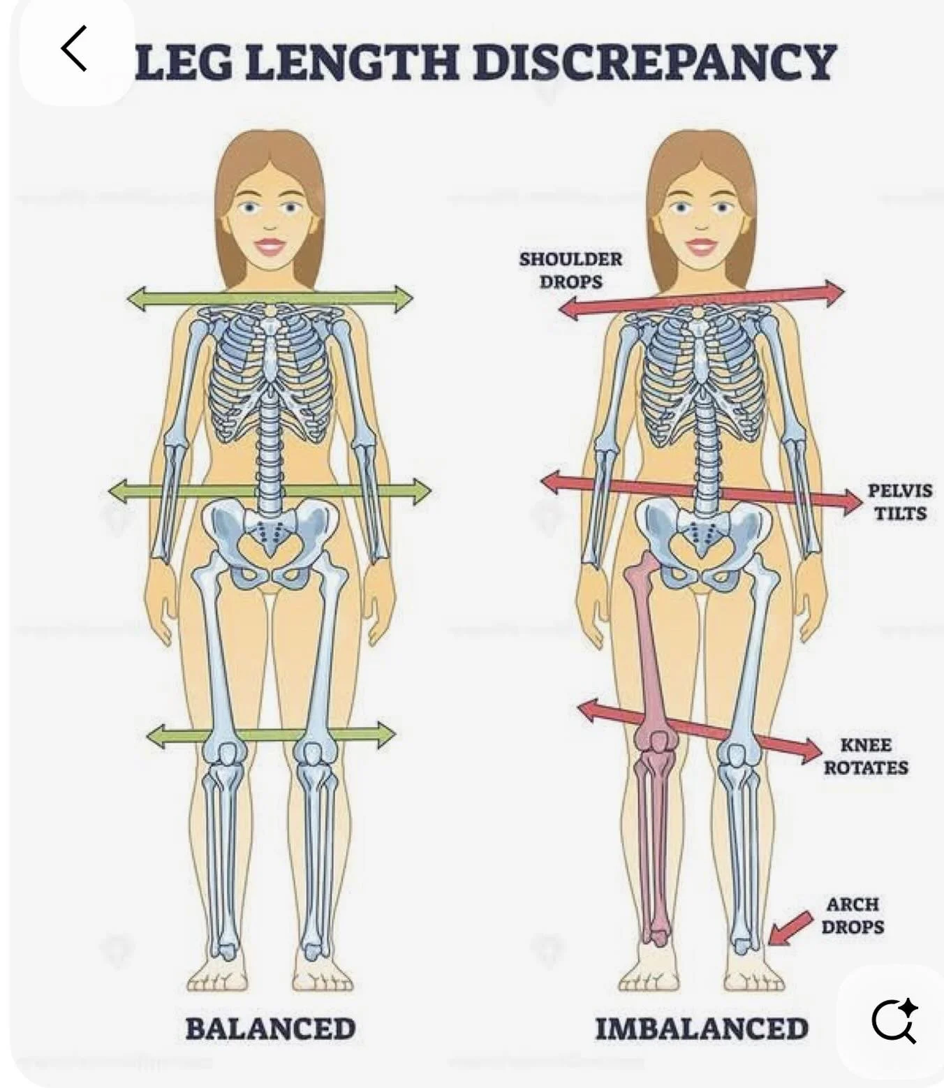 It is very rare to have true leg discrepancies unless there was a broken leg or deformation on the leg.
Most cases are the results of hip misalignments which makes one leg looks longer.