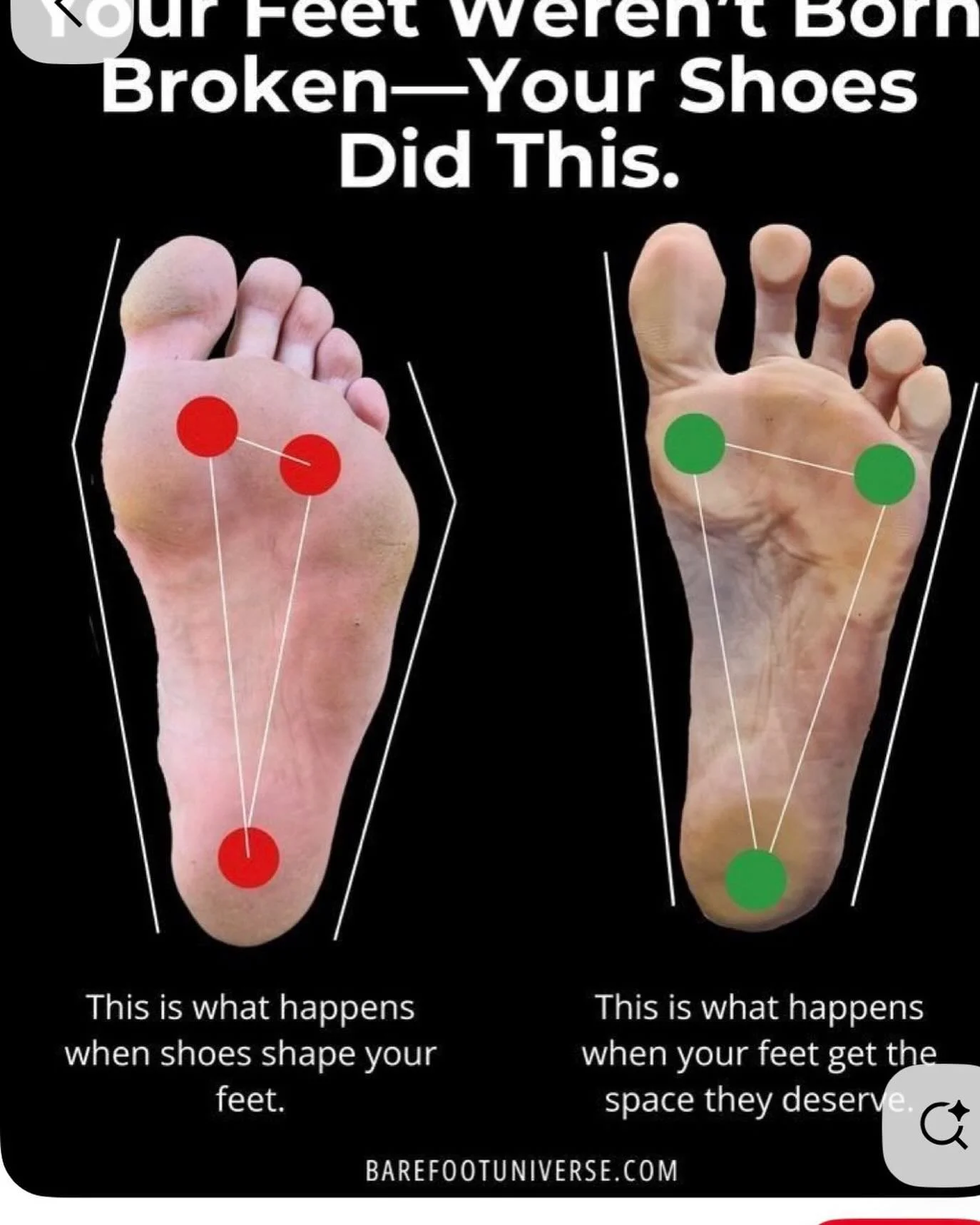 Improper shoes for feet can change the whole muscle engagements all the way to head.