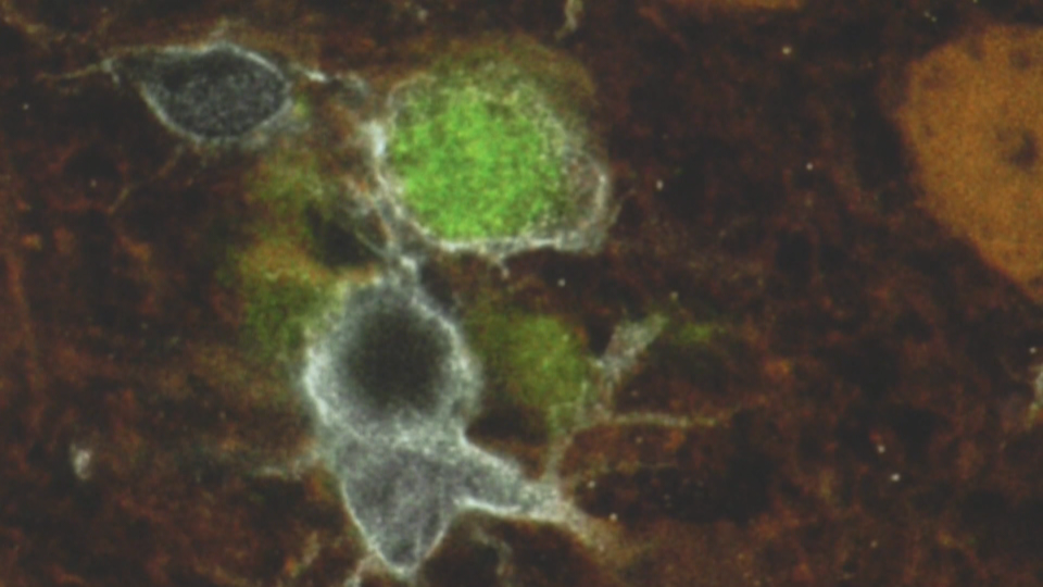 UBC lab-created brain cells hold new hope for understanding mechanics of Alzheimer’s disease