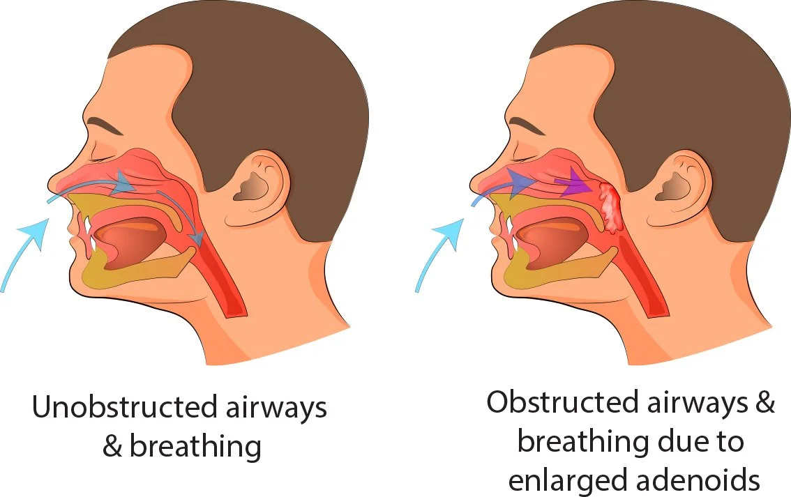 Adenoidectomy — North View ENT | Dr Sebastian Ranguis | ENT Surgery ...