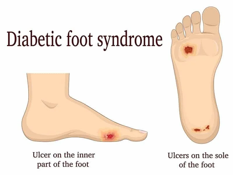 Diabetic feet showing the ulceration and circulation risks that diabetic foot care aims to detect early