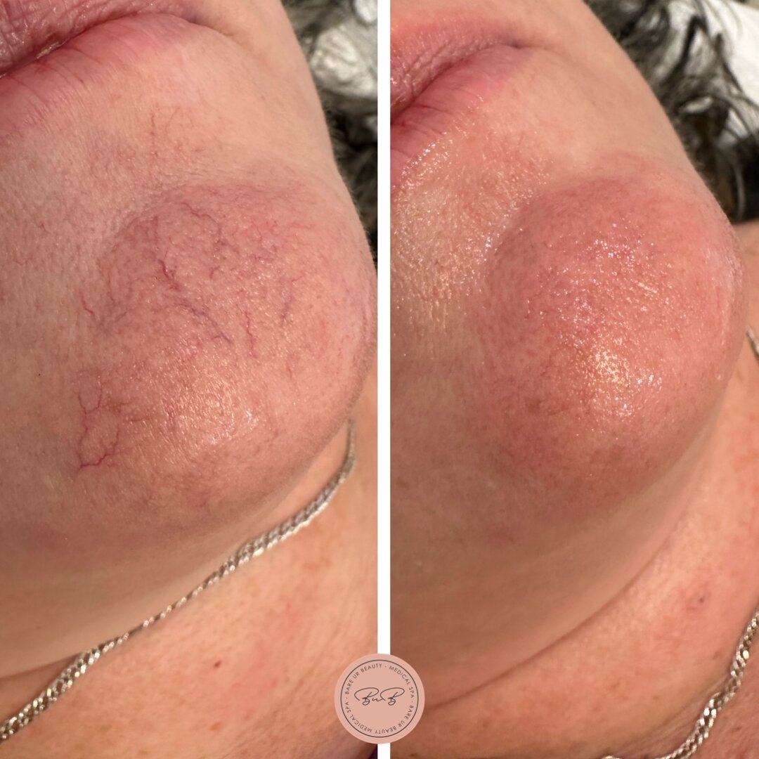 Goodbye pesky veins ⚡️​​​​​​​​
​​​​​​​​
Immediately before &amp; after treatment broken capillaries on the face. 👏🏼​​​​​​​​
​​​​​​​​
Using a laser wave length to  deliver pulses of light energy which cause the blood within the vein to coagulate, ev