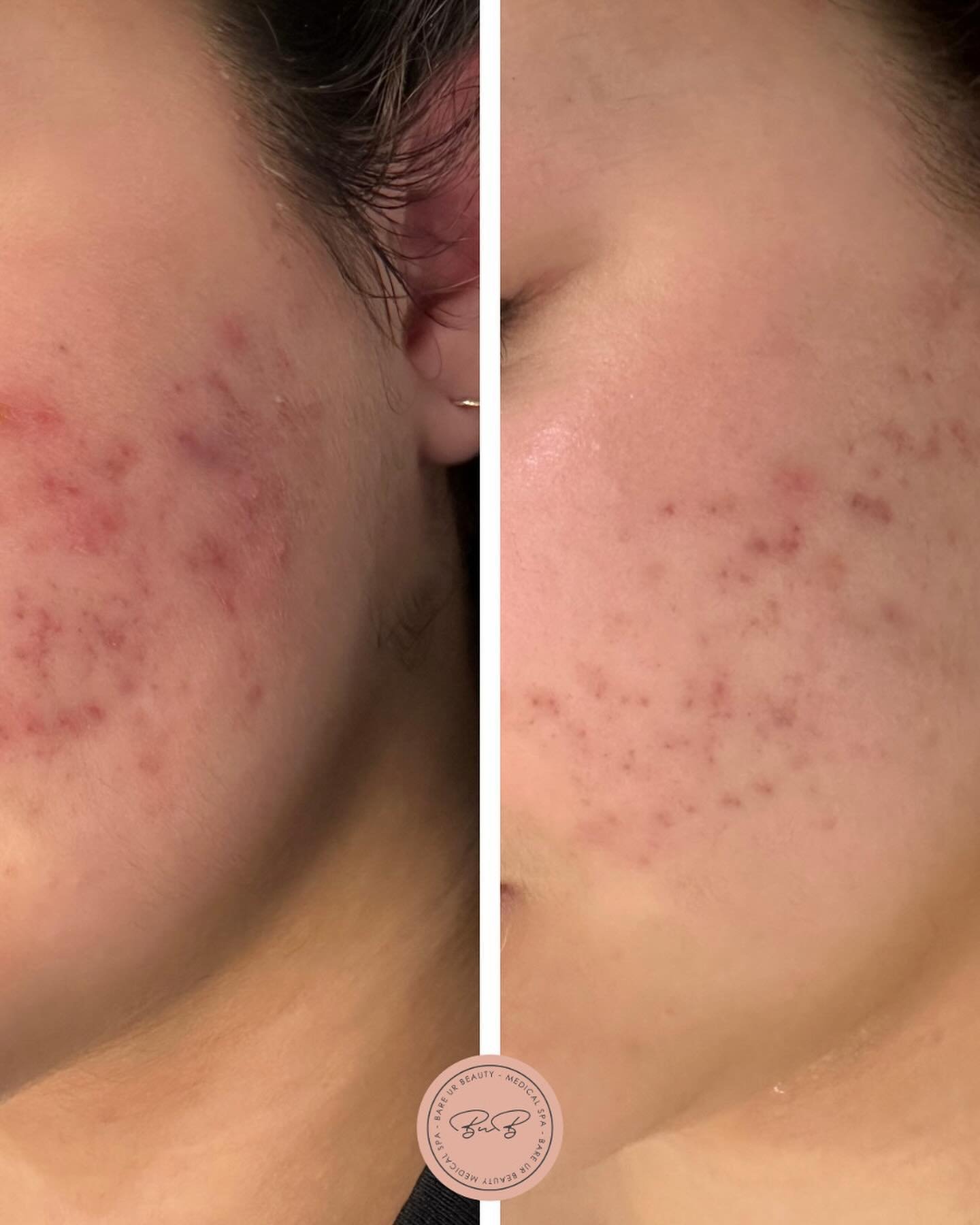 ✨We take the confusion out of Skincare!✨
⠀⠀⠀⠀⠀⠀⠀⠀⠀
This transformation is 6 weeks apart. Check out the incredible progress with these simple, effective products:
⠀⠀⠀⠀⠀⠀⠀⠀⠀
🌿 Seabuckthorn oil 
💦 Hydrinity Mist
🌟 Hydrinity Restorative Serum
☀️ SPF o