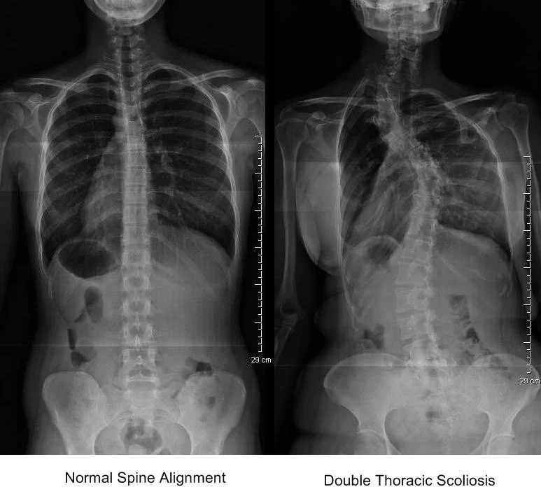 Understanding Scoliosis Twickenham Chiropractor — SYNERGY