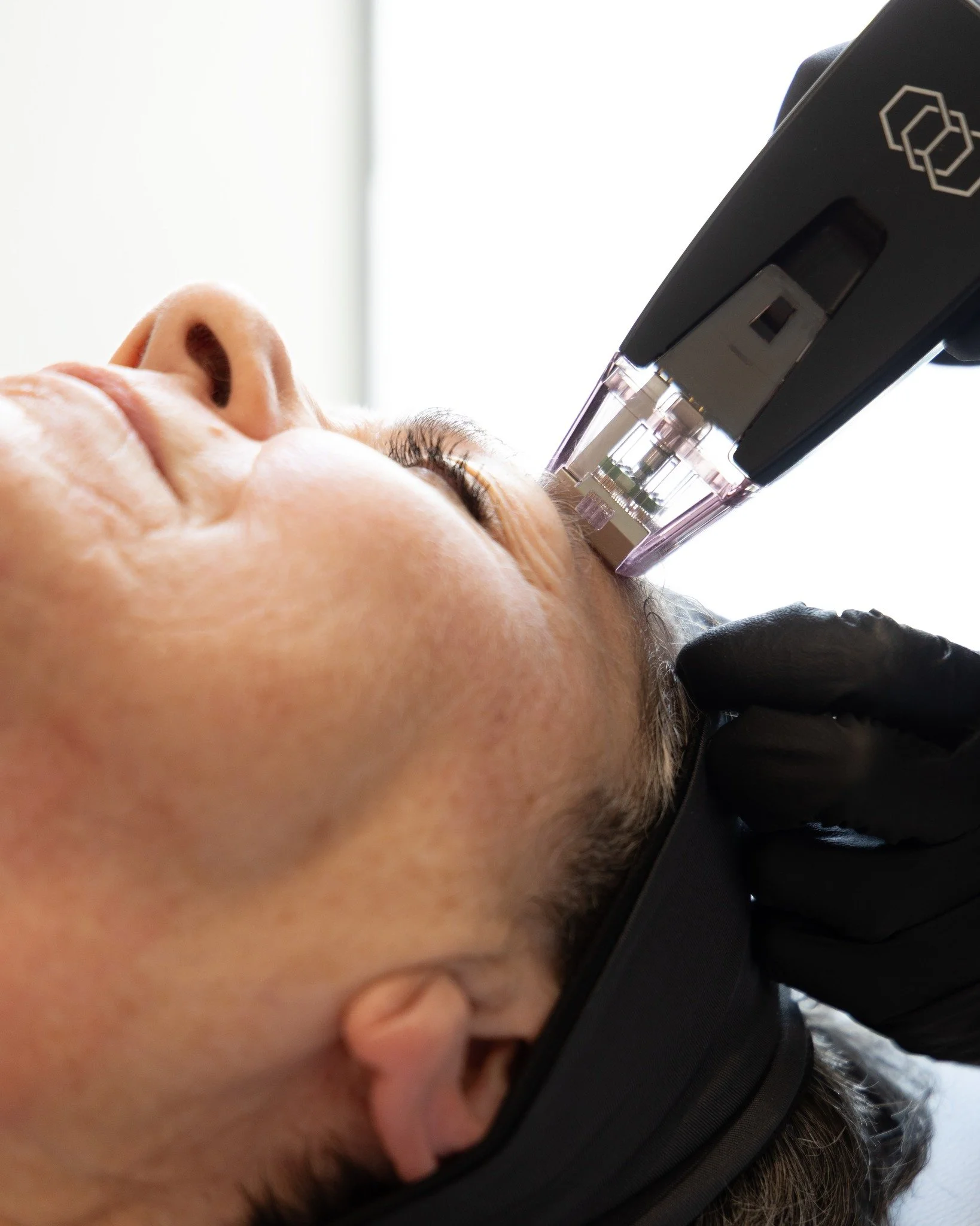 Glow from within. ✨
Morpheus8 combines microneedling with radiofrequency energy to remodel collagen deep beneath your skin's surface&mdash;targeting fine lines, acne scars, and skin laxity where it matters most.
The result? Tighter, smoother, more ra