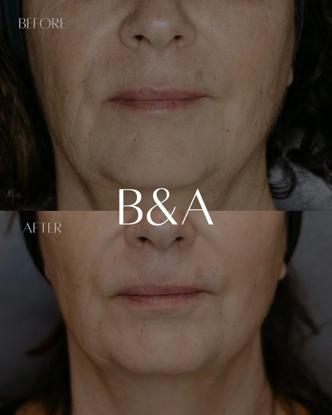 One IPL treatment. Medical-grade foundation. Real results.

Notice the reduction in fine lines and visible fading of hyperpigmentation on the upper lip and chin after just ONE session.

Why skincare comes first:

We started this client on clinical-gr