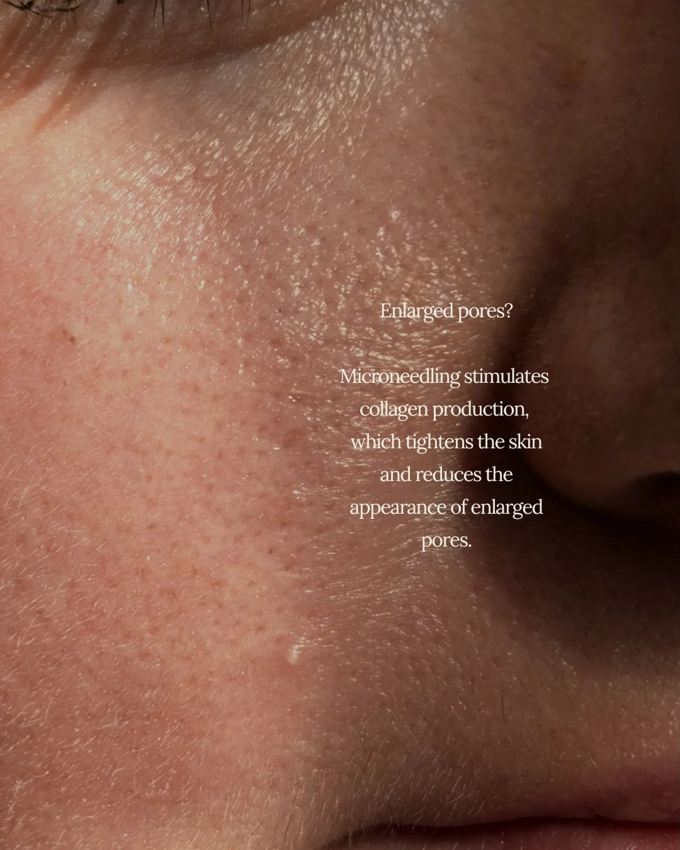 Say goodbye to enlarged pores! ✨ Microneedling stimulates collagen production, tightening your skin and leaving your pores looking smaller and smoother. 
#saltdayspa #yegspa #Microneedling #SkinCareScience #GlowingSkin