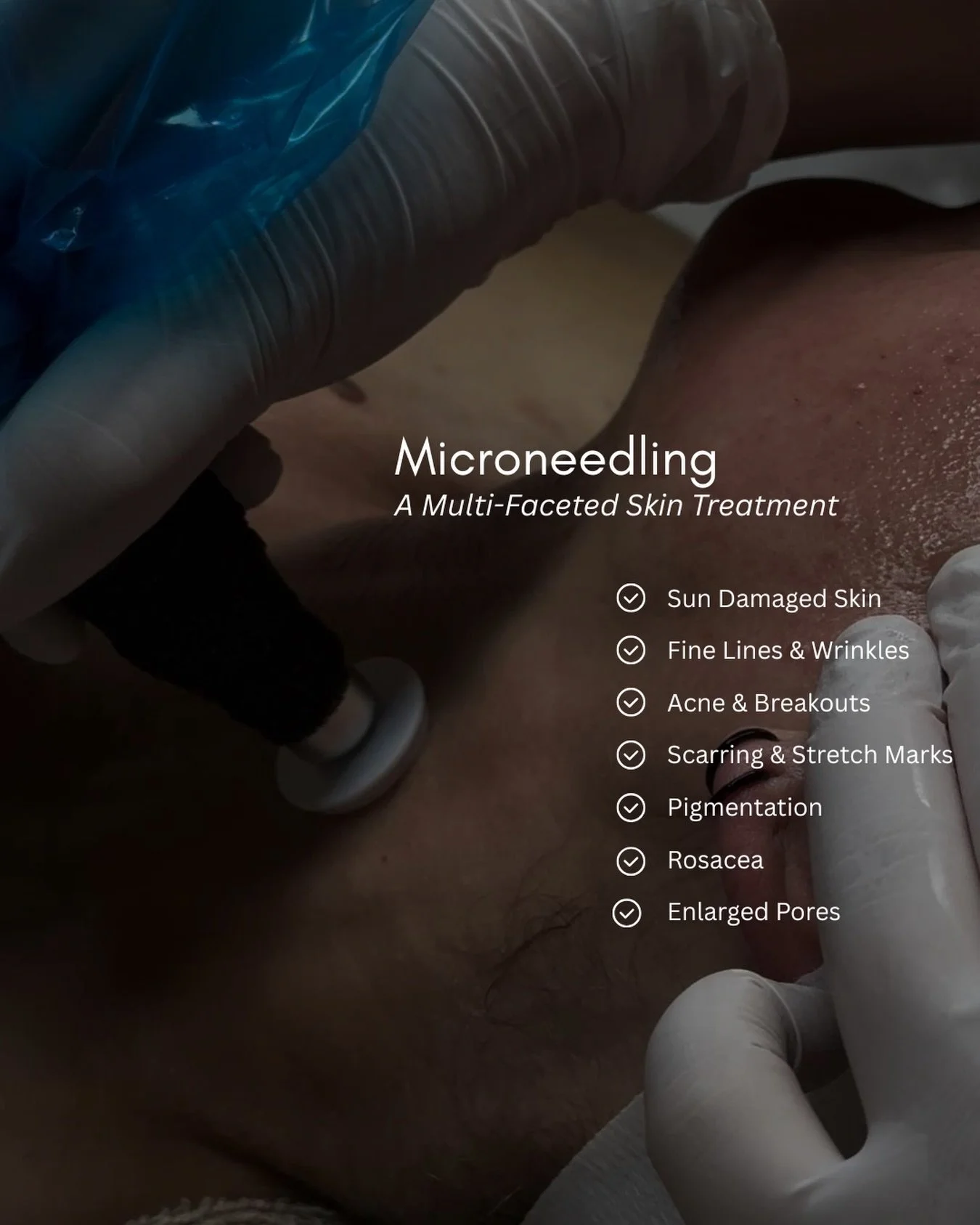 Not just a glow, actual change in your skin.

Microneedling helps soften find lines, improve texture, and bring your skin back to life by encouraging natural repair.

It&rsquo;s one of our go to treatments when you&rsquo;re ready to take your skin ca