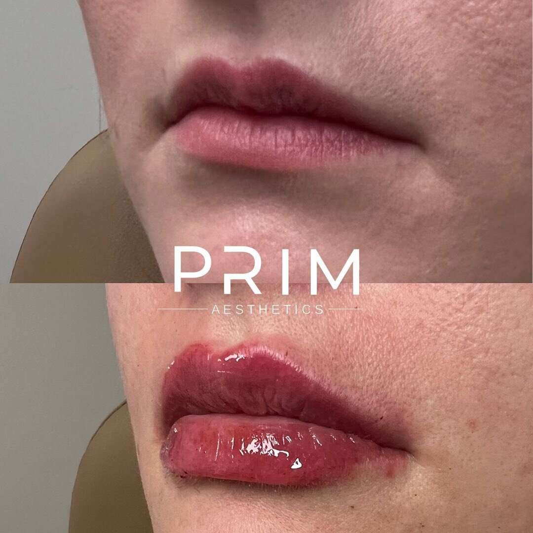 POV: you try lip filler for the first time and now you&rsquo;re obsessed 

We have so many lip filler newbies lately and we love it! Whether you want to address asymmetries, volume or hydration-we got you! Schedule a consultation if you want to ask q