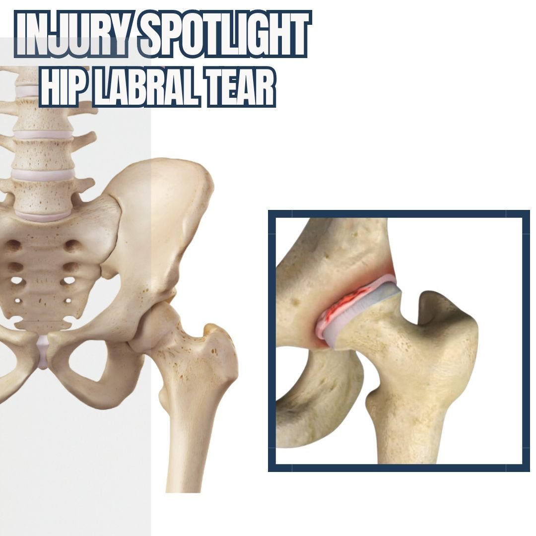 I N J U R Y  S P O T L I G H T : L A B R A L  T E A R 

What is the hip labrum? : The hip labrum is a piece of fibrocartilage that helps the hip joint to move smoothy in all directions. It acts like a suction cup, to keep the head of the femur in the