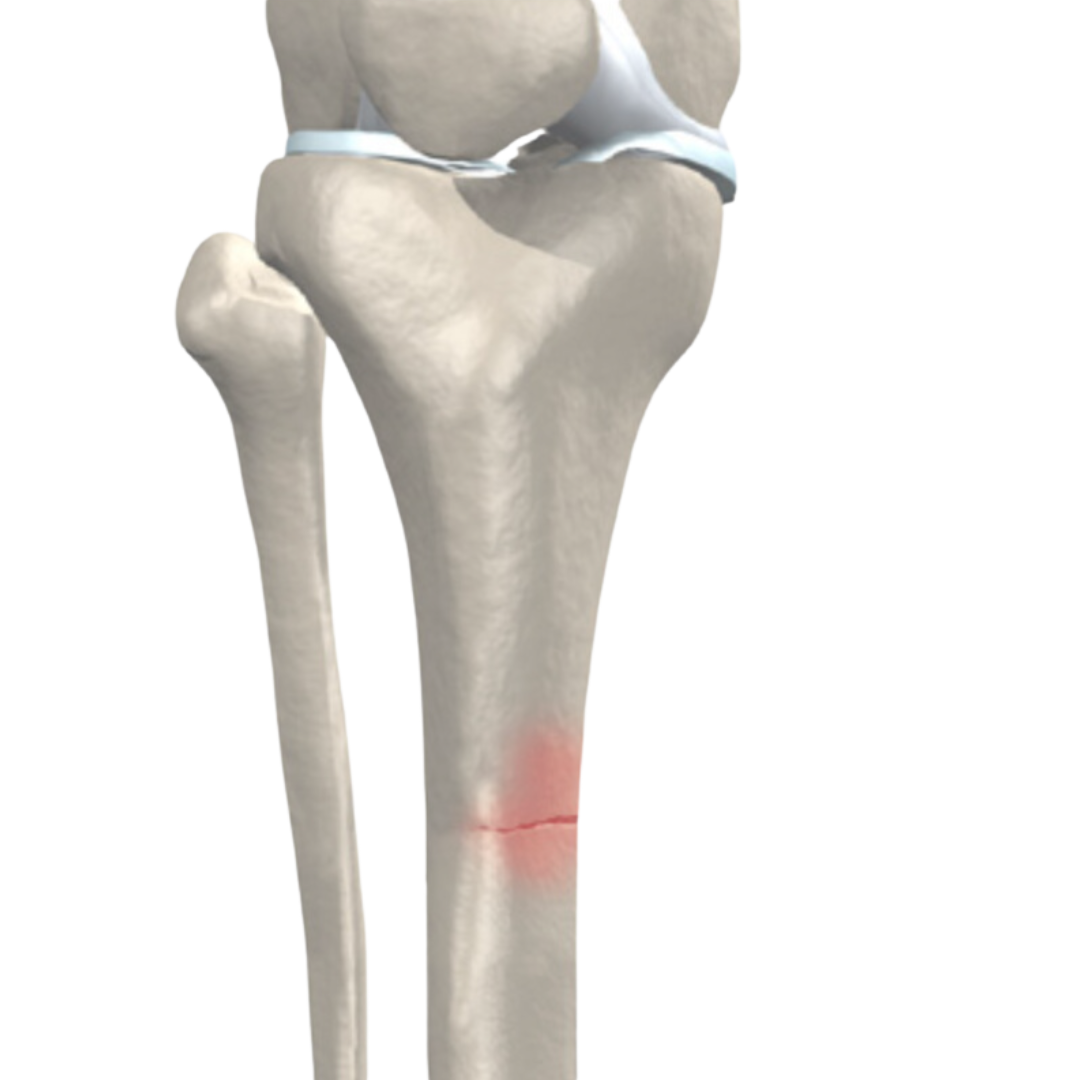 Éruption Tibia Stress Reaction Tibia Symptoms