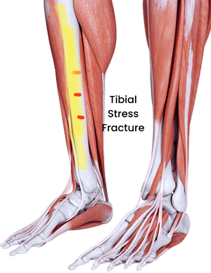A Complete Guide to Bone Stress Injury in Runners — The Run Rx