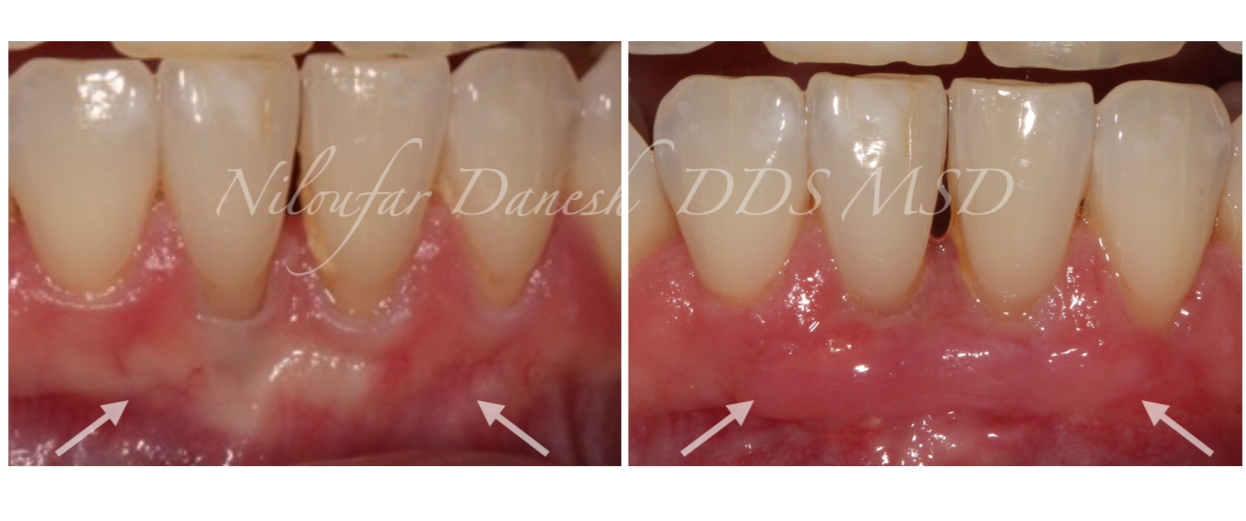 Gum Graft