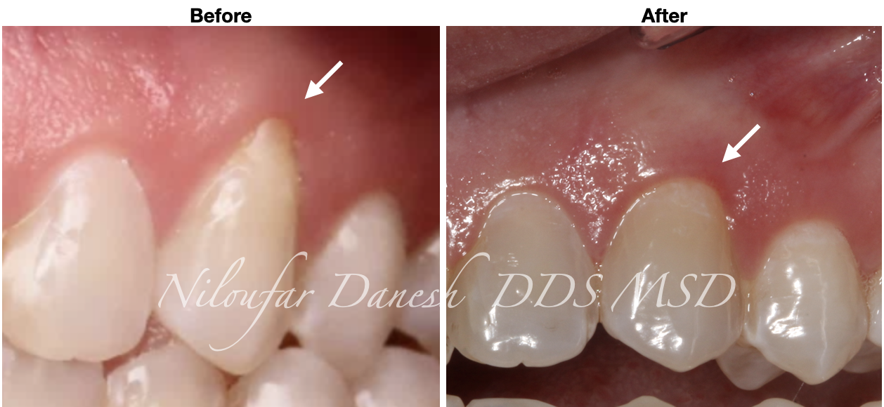 Root Coverage with Soft Tissue Graft