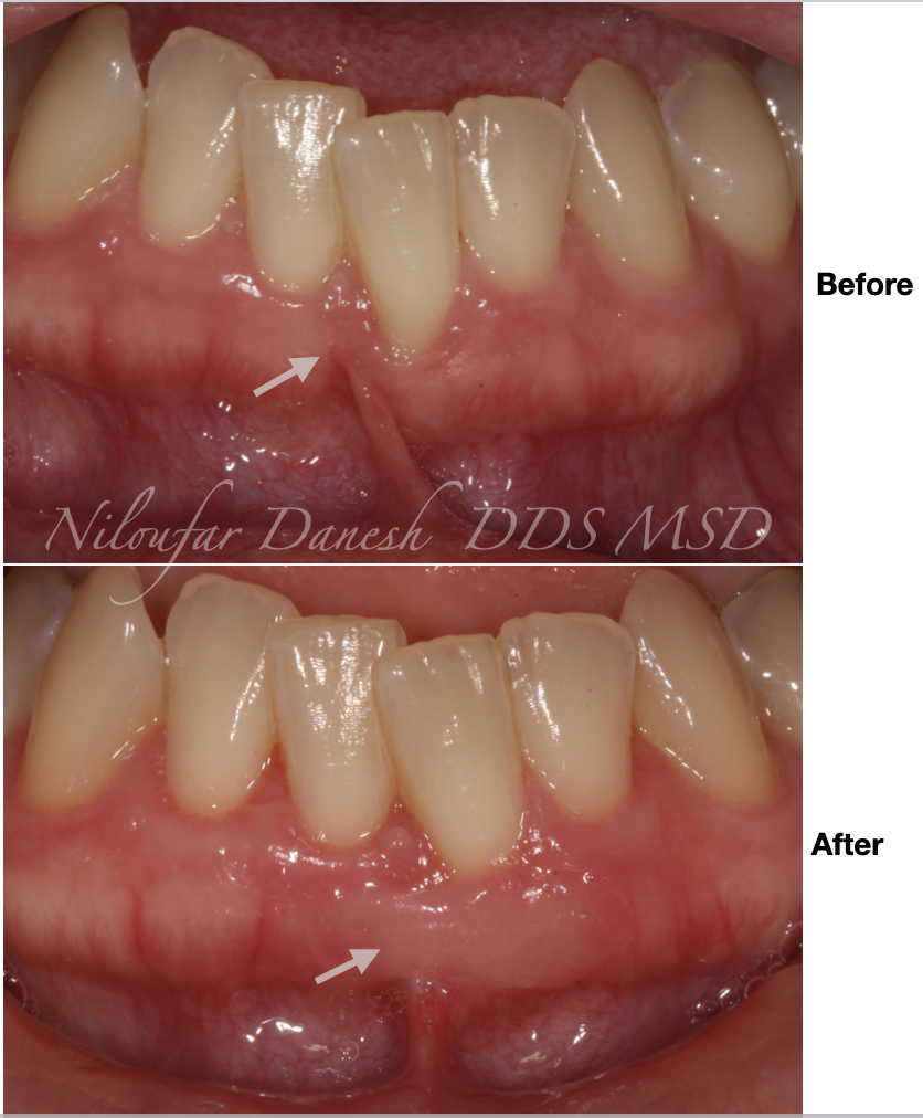Root Coverage with Soft Tissue Graft