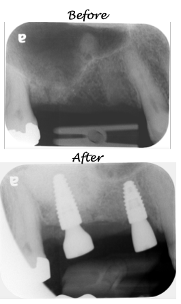 Sinus Lift & Implant Placement