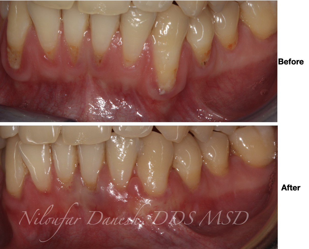 Root Coverage with Soft Tissue Graft