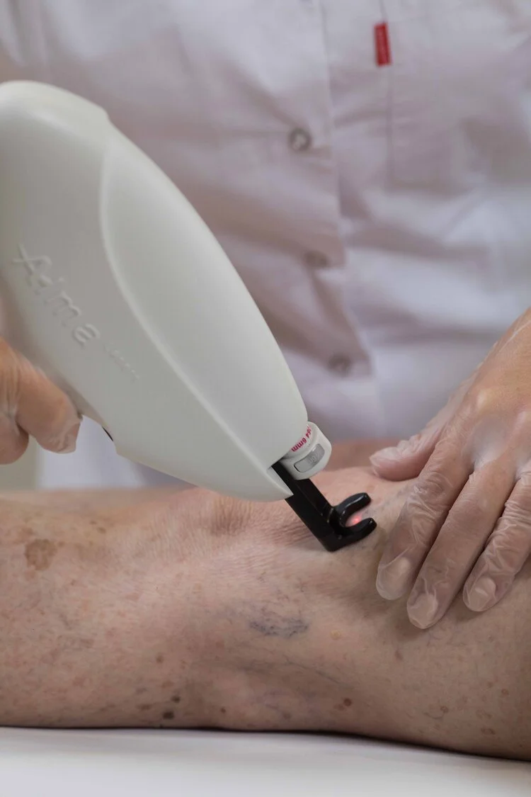 Person receiving laser skin treatment on the leg, performed by a gloved technician.