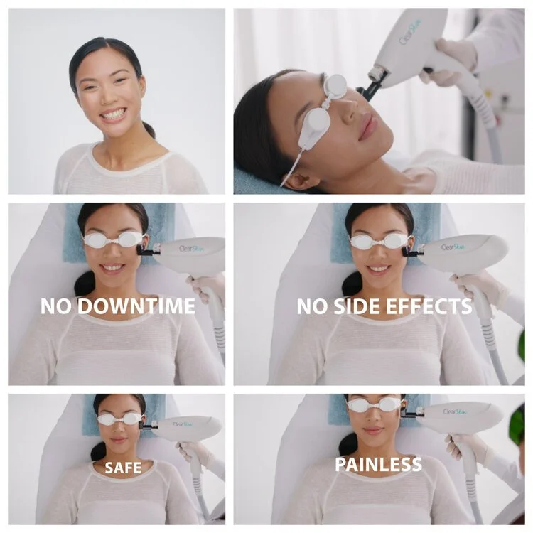 A collage of images showing a woman undergoing a skincare treatment using a device labeled ClearSkin. She is seen smiling and lying down with protective goggles. Text highlights benefits of the treatment: "No Downtime," "No Side Effects," "Safe," and "Painless."