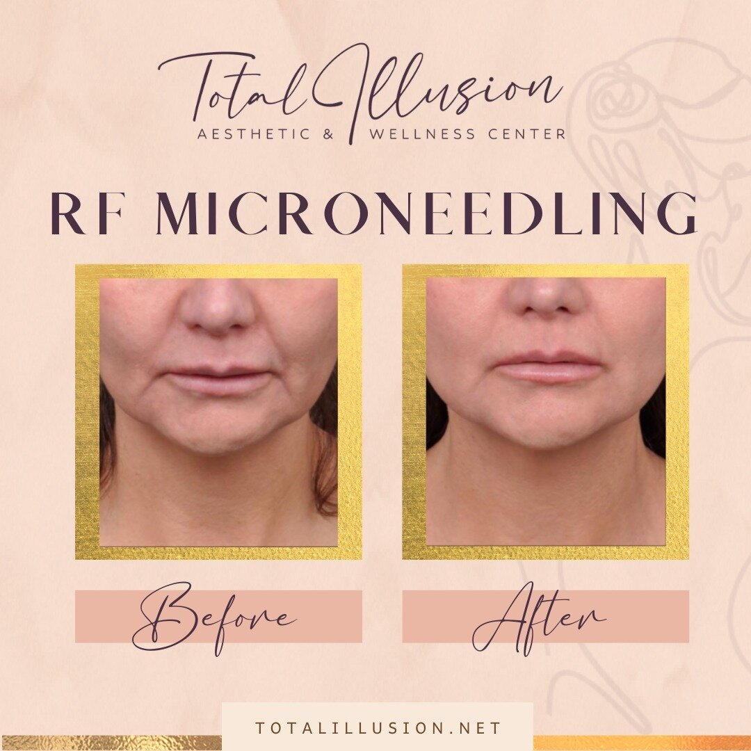 Amazing results with RF microneedling 🤩

RF Microneedling can help you slow down the signs of aging 🙌

➡️ Little downtime and fast results! Come in and see if this treatment is right for you!

Book now!
📞 (562) 431-7779

Visit us:
📍1500 Pacific C